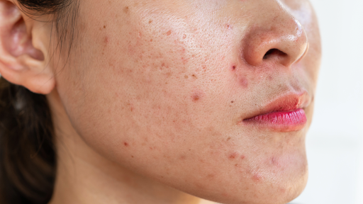 acne treatment Las Vegas