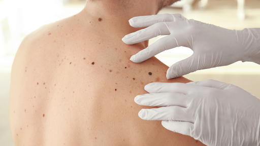Skin cancer diagnosis and treatment consultation in Las Vegas